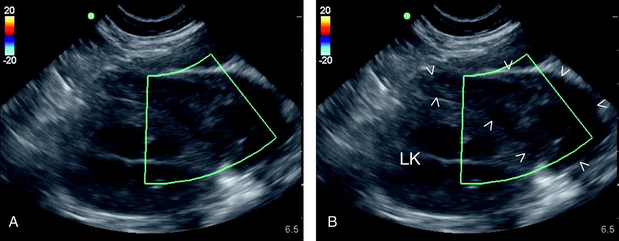 Figure 76 Clotted blood adjacent to the left kidney at the SR view In - фото 84