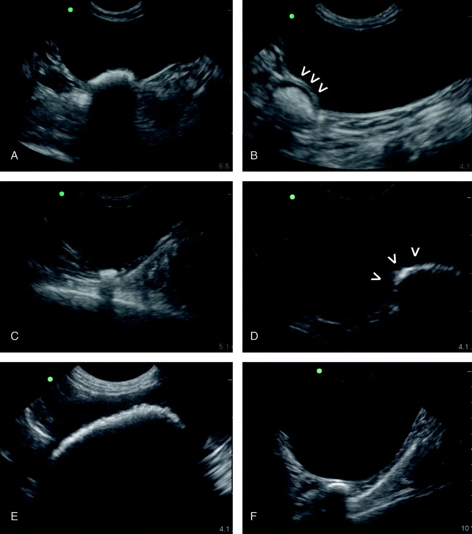 Figure 627 Calculi versus intestinal tract The sonographer will readily - фото 74
