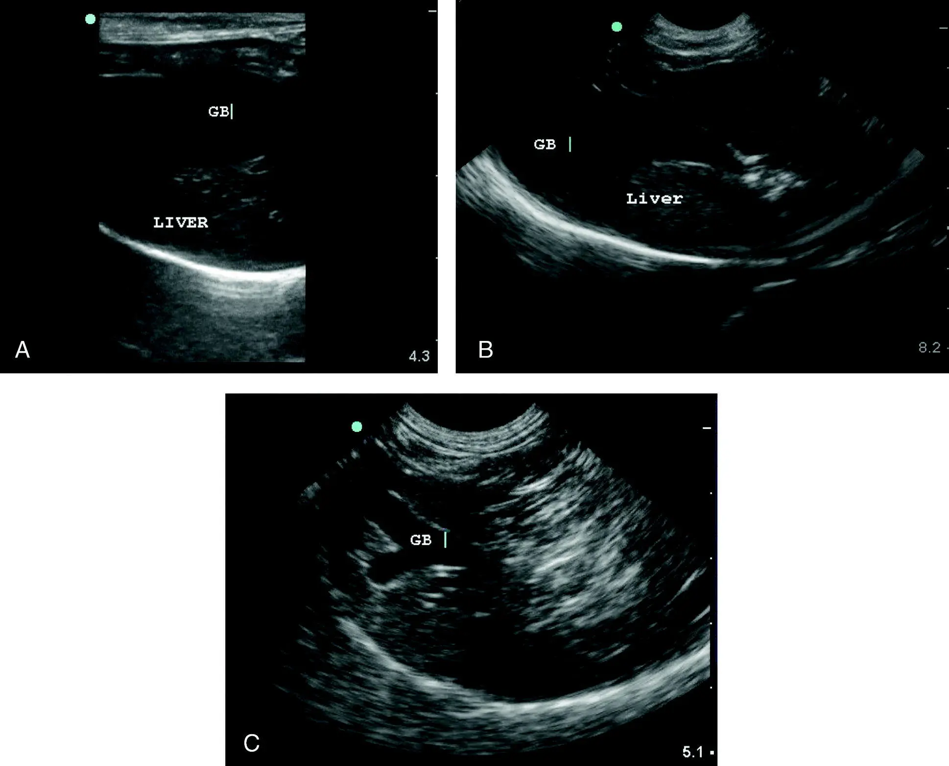 Figure 84 Normal gallbladder and variations A The normal gallbladder wall - фото 97