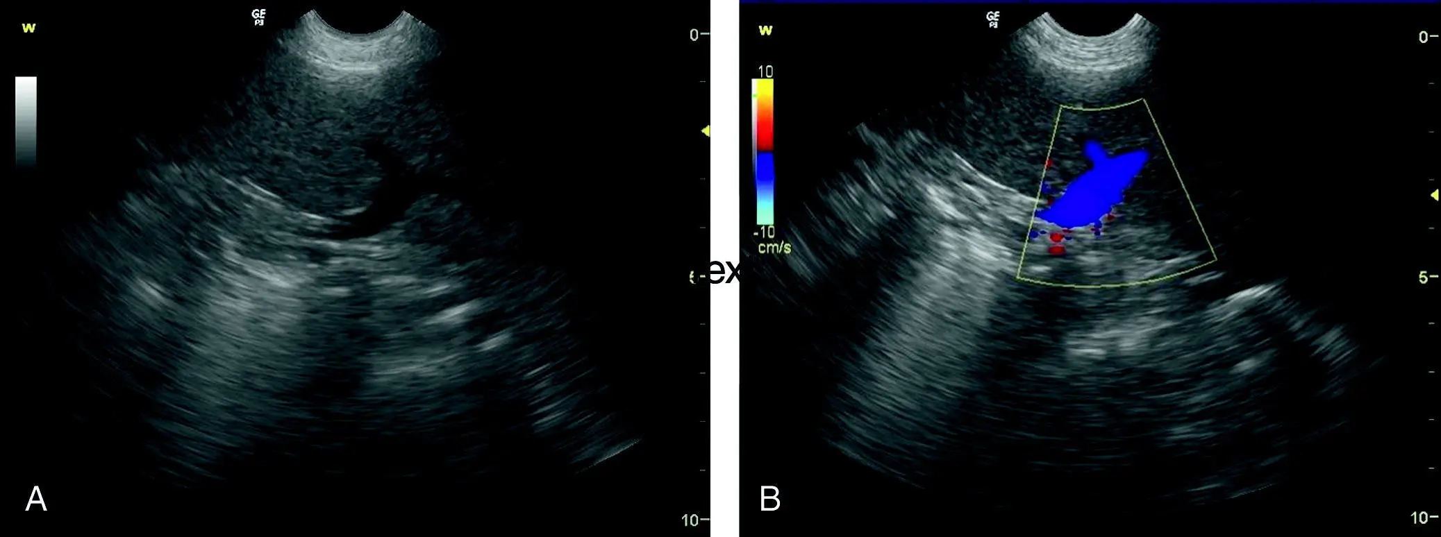 Figure 91 Normal splenic hilus A The Y shape of the splenic vein also - фото 101