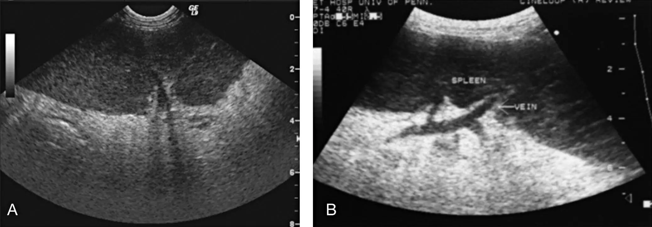 Figure 916 Splenic torsion vascular lesion A Image of the splenic hilus in - фото 113