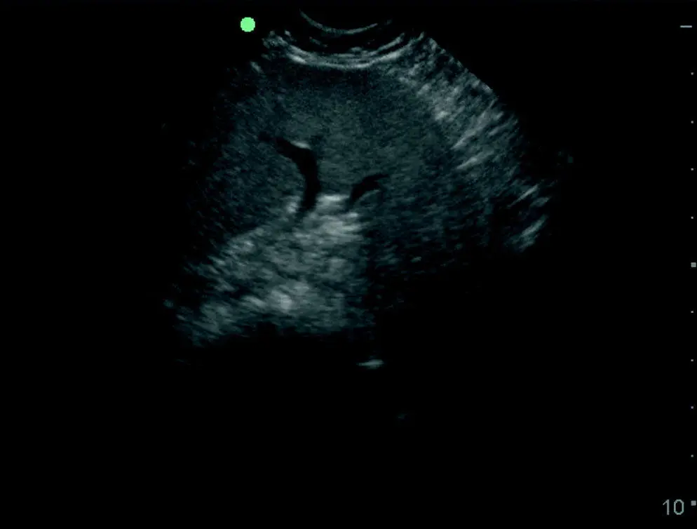 Figure 92 Subjective size evaluation of the spleen Splenic enlargement as - фото 102