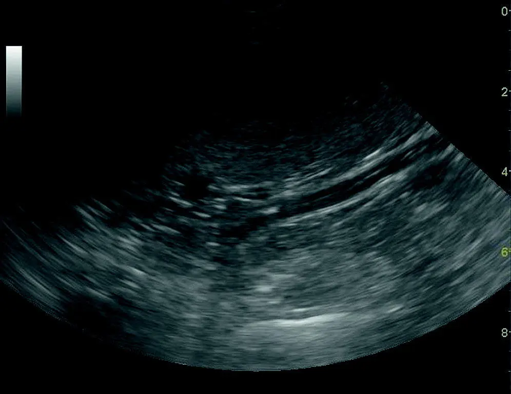 Figure 97 Splenomegaly with normal echogenicity Infectious diseases can - фото 107