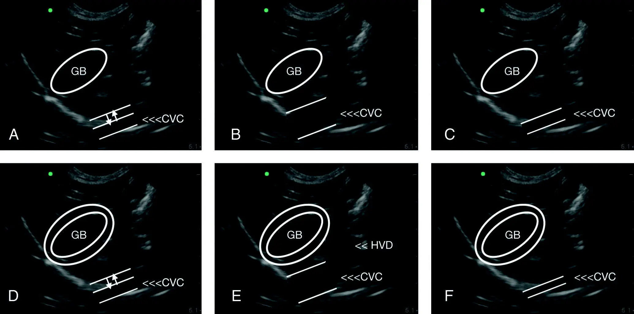 Figure 712 Integrating gallbladder wall edema with characterization of the - фото 90