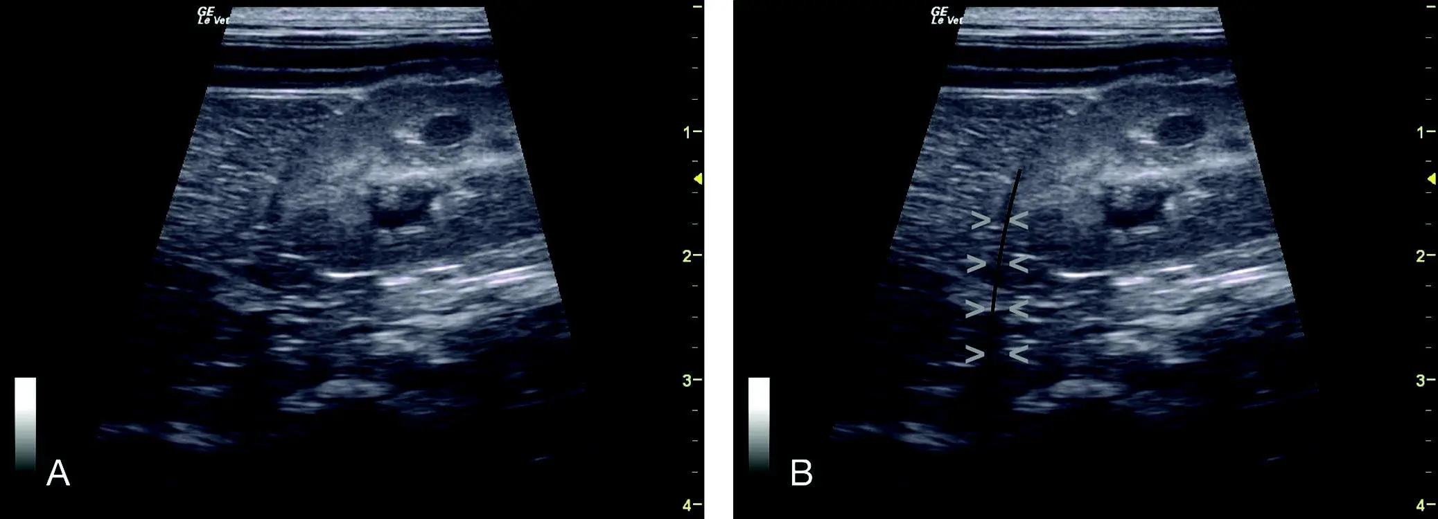 Figure 620 Edge shadowing artifact off the left kidney A and B are the - фото 67