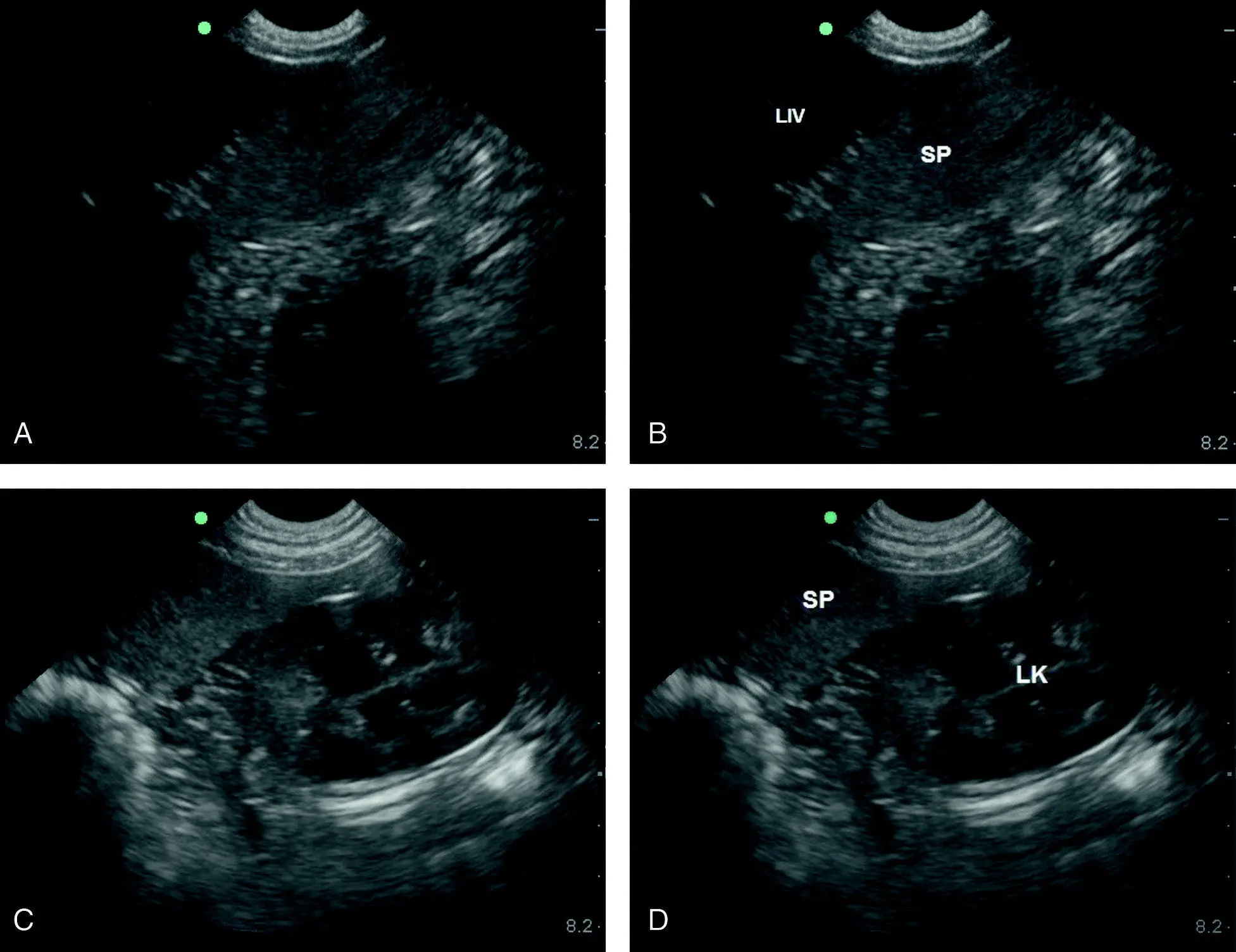 Figure 93 Echogenicity of spleen relative to liver and cortex of kidney A - фото 103