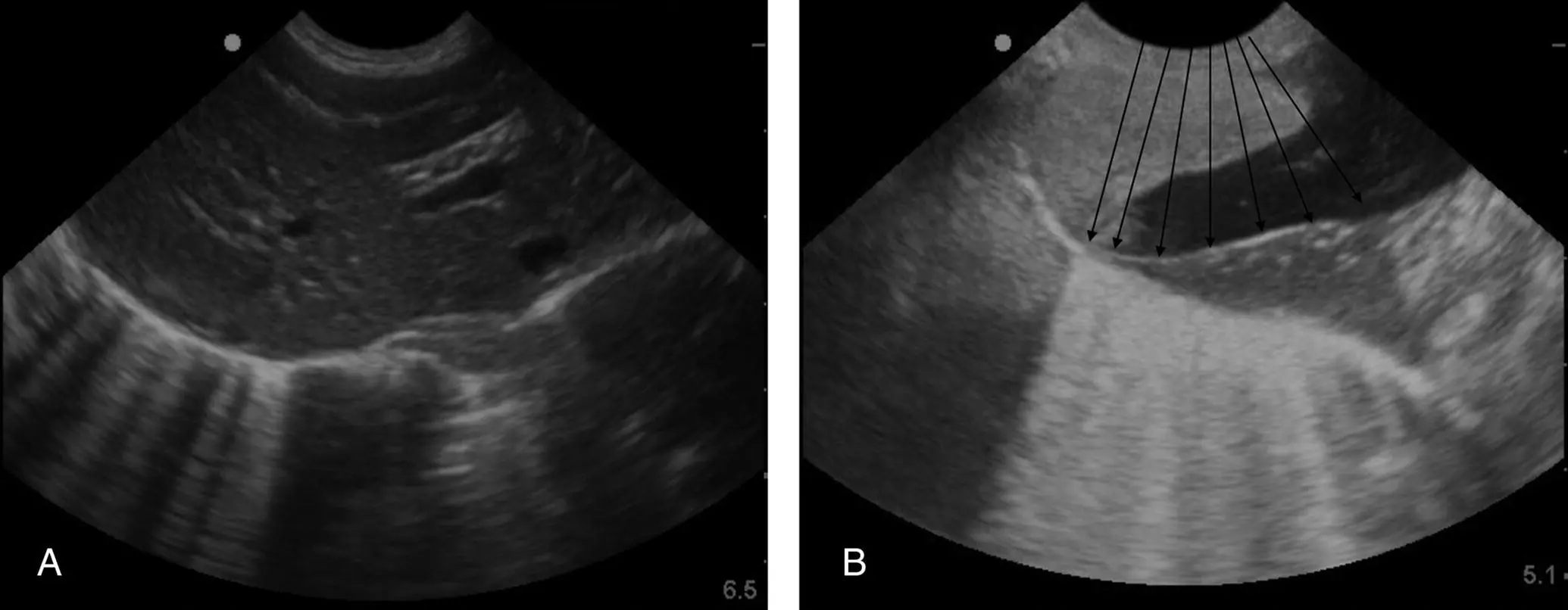 Figure 614 Showing Blines along the pulmonarydiaphragmatic interface - фото 61