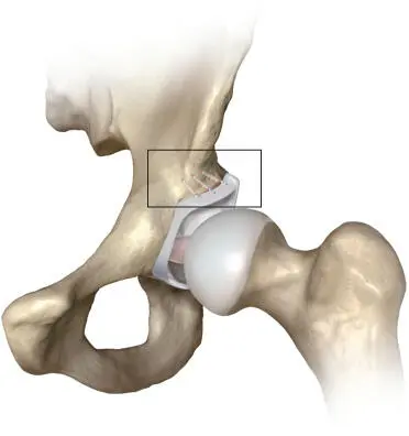 Figure 11BioComposite Knotless SutureTak anchor used in hip arthroscopy - фото 2
