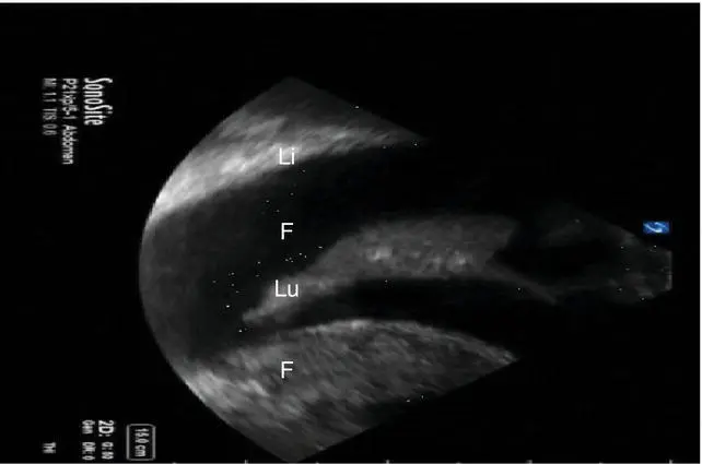 Figure 47 Pleural effusion Anechoic fluid F surrounding lung Lu Note the - фото 23