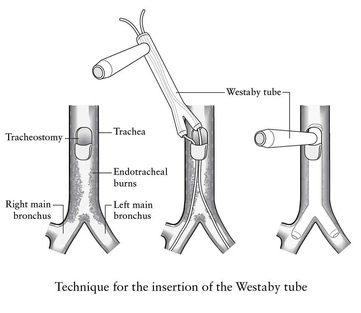 The following day we took him to theatre removed the tracheostomy tube and - фото 4