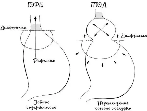 Рис 11 Отличия грыжи ГПОД от рефлюкса ГЭРБ Конечно это совсем разные - фото 14