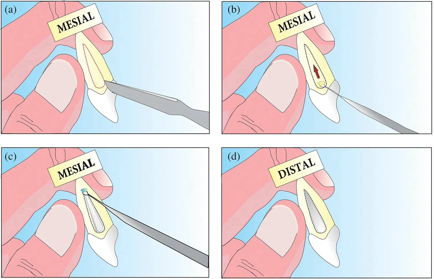 Figure 25 ad Carving the developmental depression on the root portion using - фото 15