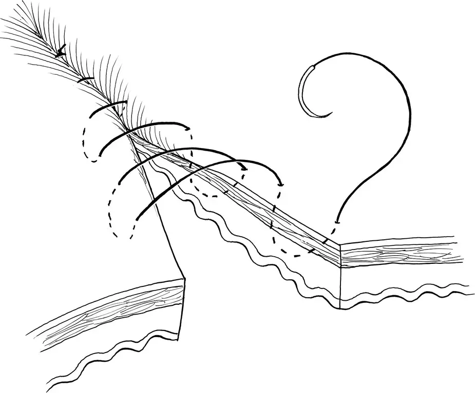 Figure 33 Figure 34 353 Lembert This interrupted or continuous - фото 12