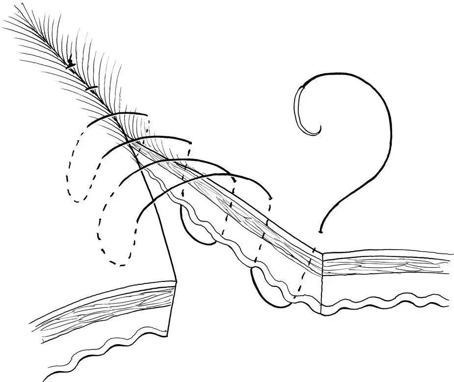 Figure 34 353 Lembert This interrupted or continuous pattern results in - фото 13