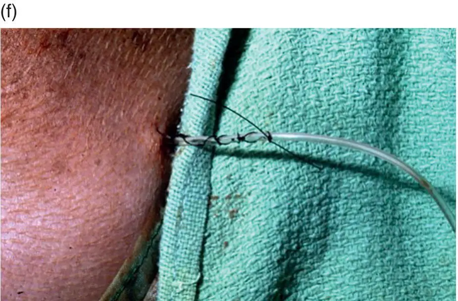Figure 410 445 Utilization A jejunostomy feeding tube can be used - фото 27