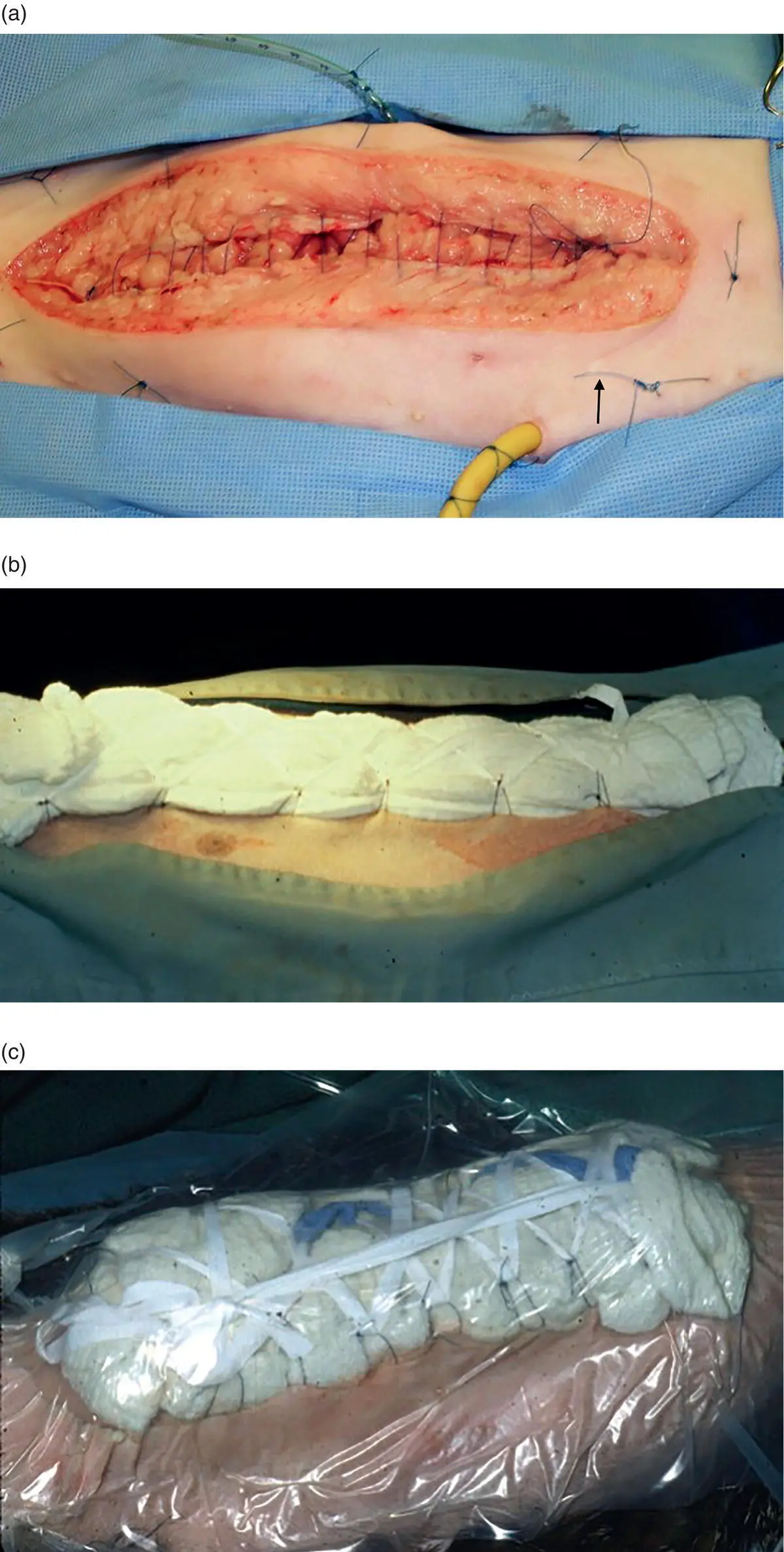 Figure 54 With an open abdomen it is paramount that the bandage change and - фото 32