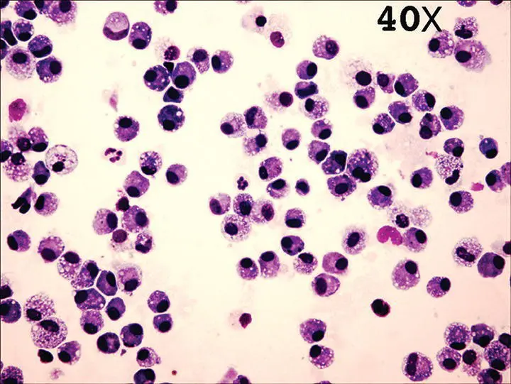 Figure 225 Cytocentrifuge of a normal bronchoalveolar lavage sample 40 - фото 33