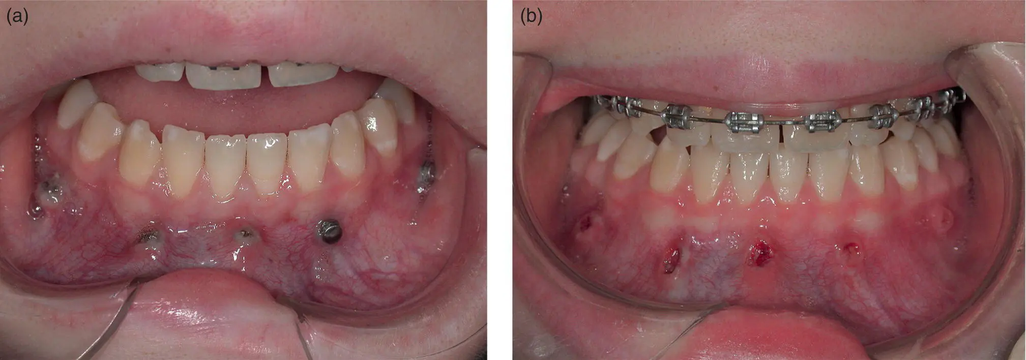 Figure 15 Overgrowth of the labial sulcular tissues caused by these mandibular - фото 4