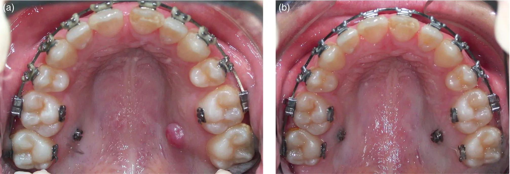 Figure 17 a Hyperplasia of the palatal mucosa covering an overinserted - фото 6