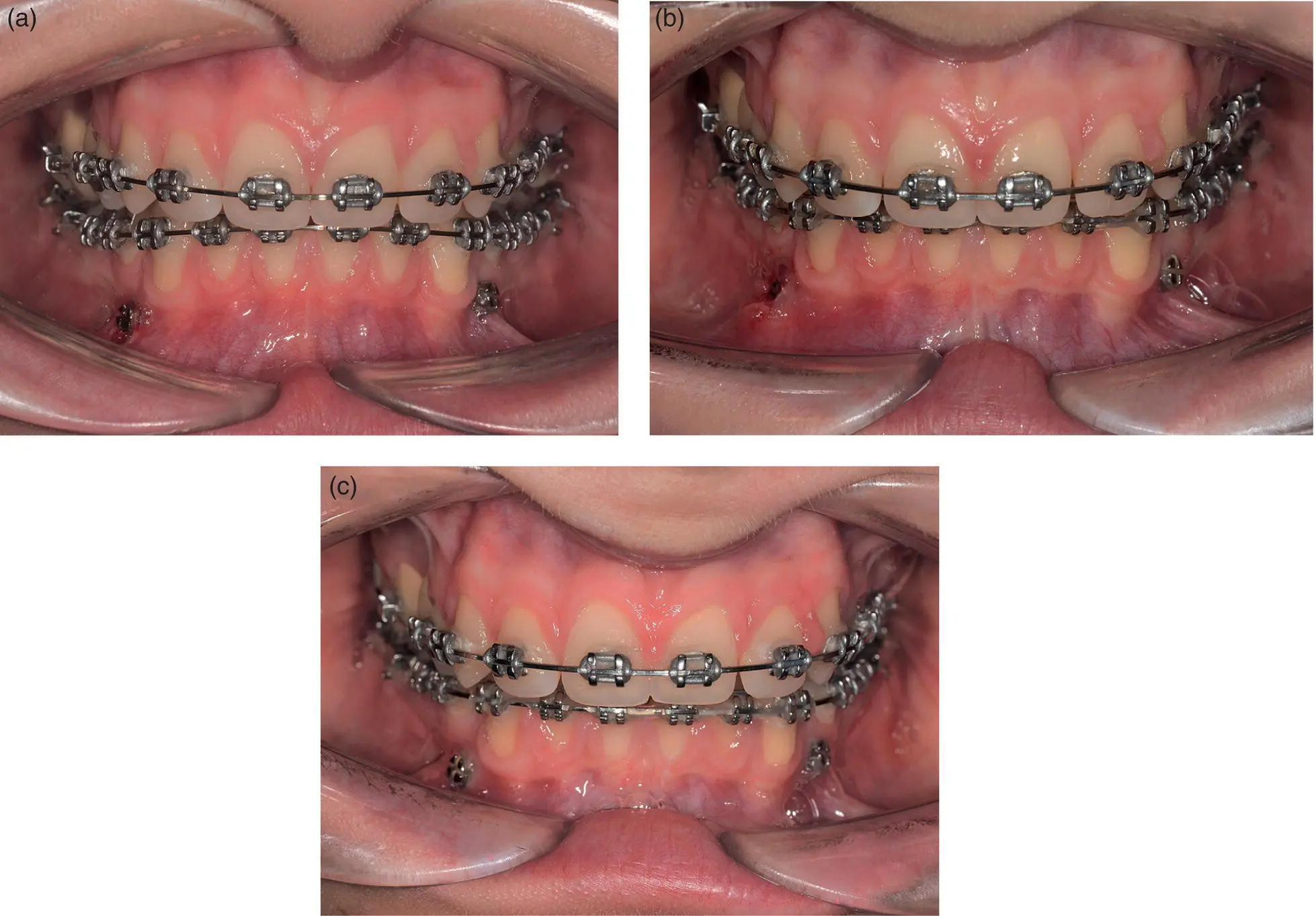 Figure 16 a Photograph of lower anterior miniimplants immediately after - фото 5