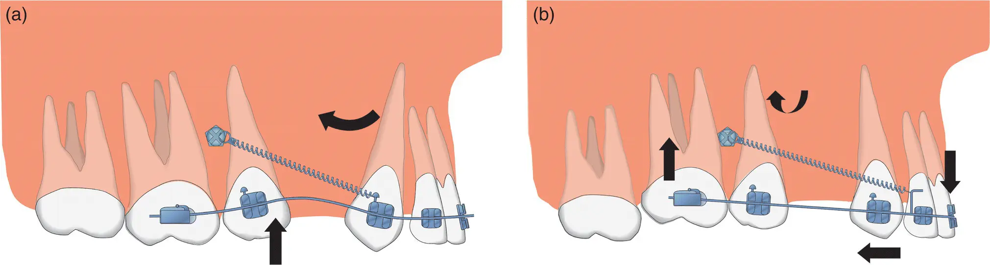 Figure 110 Diagrams showing the vertical sideeffects of an oblique vector of - фото 9