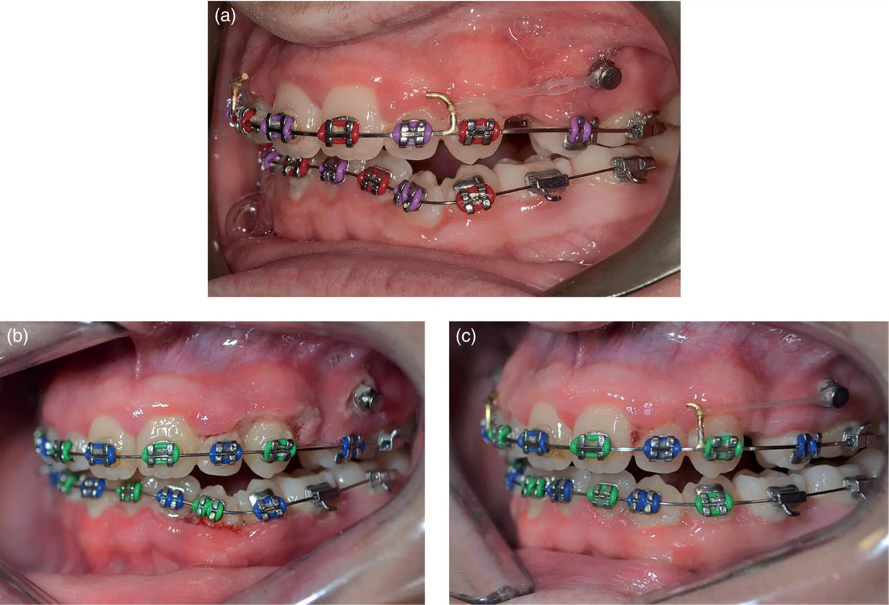 Figure 19 a Elastomeric traction auxiliary in contact with the alveolar - фото 8