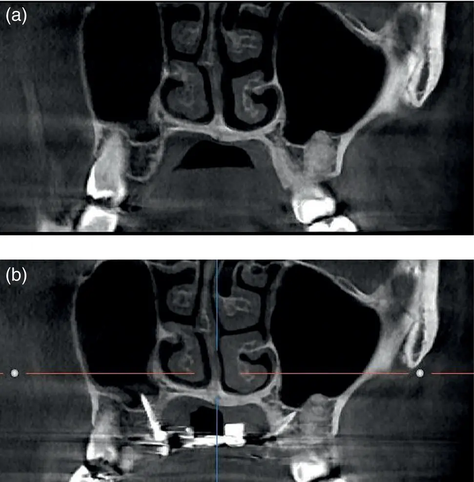 Figure 13 Coronal slice views of a CBCT scan of the maxilla a before and b - фото 2