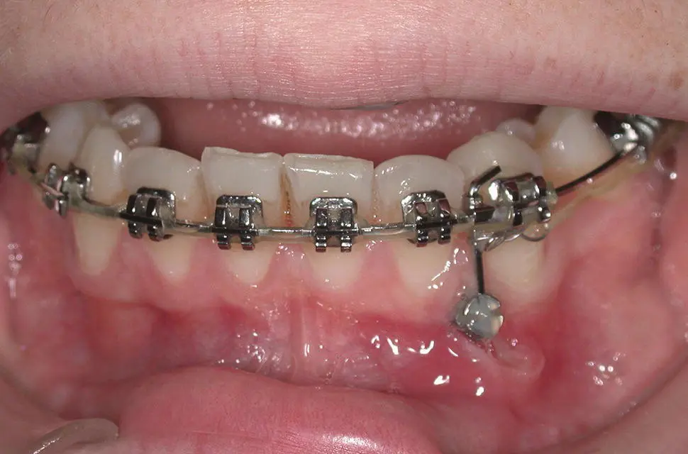 Figure 18 Labial ulceration caused by this mandibular miniimplants insertion - фото 7