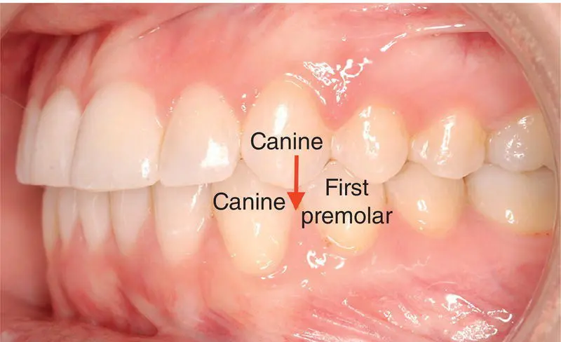 Figure 38 Class I canine relationship Figure 39 Class II canine - фото 15