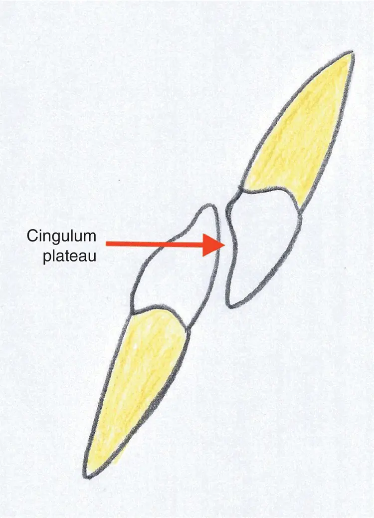 Figure 36 Incisor relationship class II div II Figure 37 Incisor - фото 13