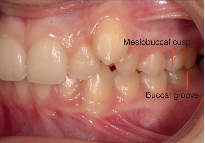 Figure 32 Class II molar relationship Figure 33 Class III molar - фото 9