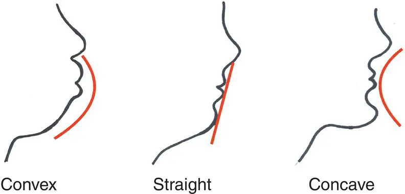 Figure 28 The different profile patterns 23 IntraOral Assessment There - фото 7
