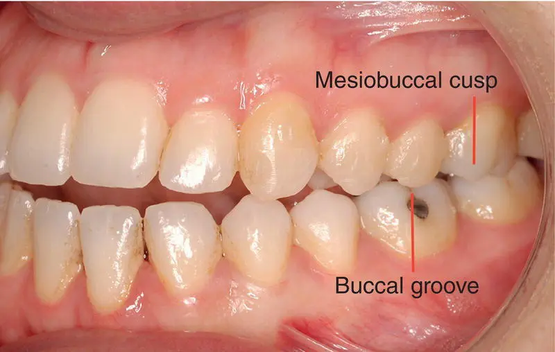 Figure 33 Class III molar relationship 32 British Standards Institute - фото 10
