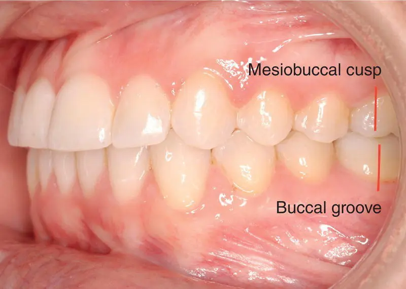 Figure 31 Class I molar relationship Figure 32 Class II molar relationship - фото 8