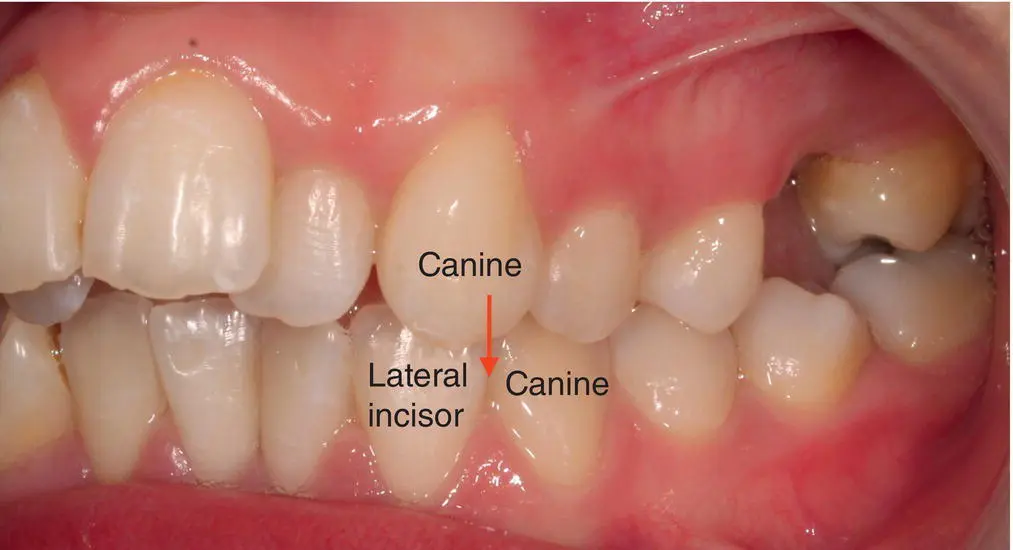 Figure 39 Class II canine relationship Figure 310 Class III canine - фото 16