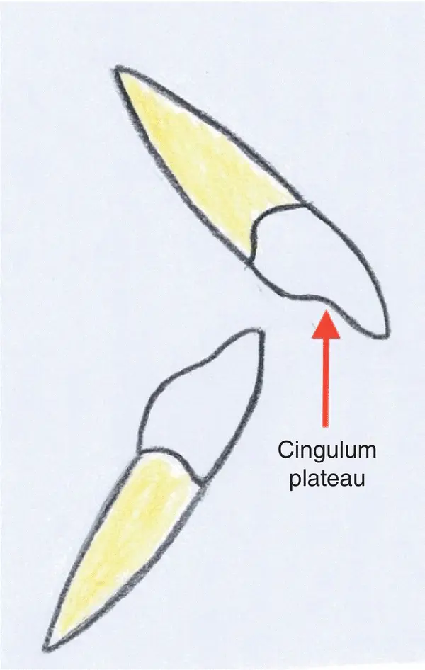 Figure 35 Incisor relationship class II div I Figure 36 Incisor - фото 12