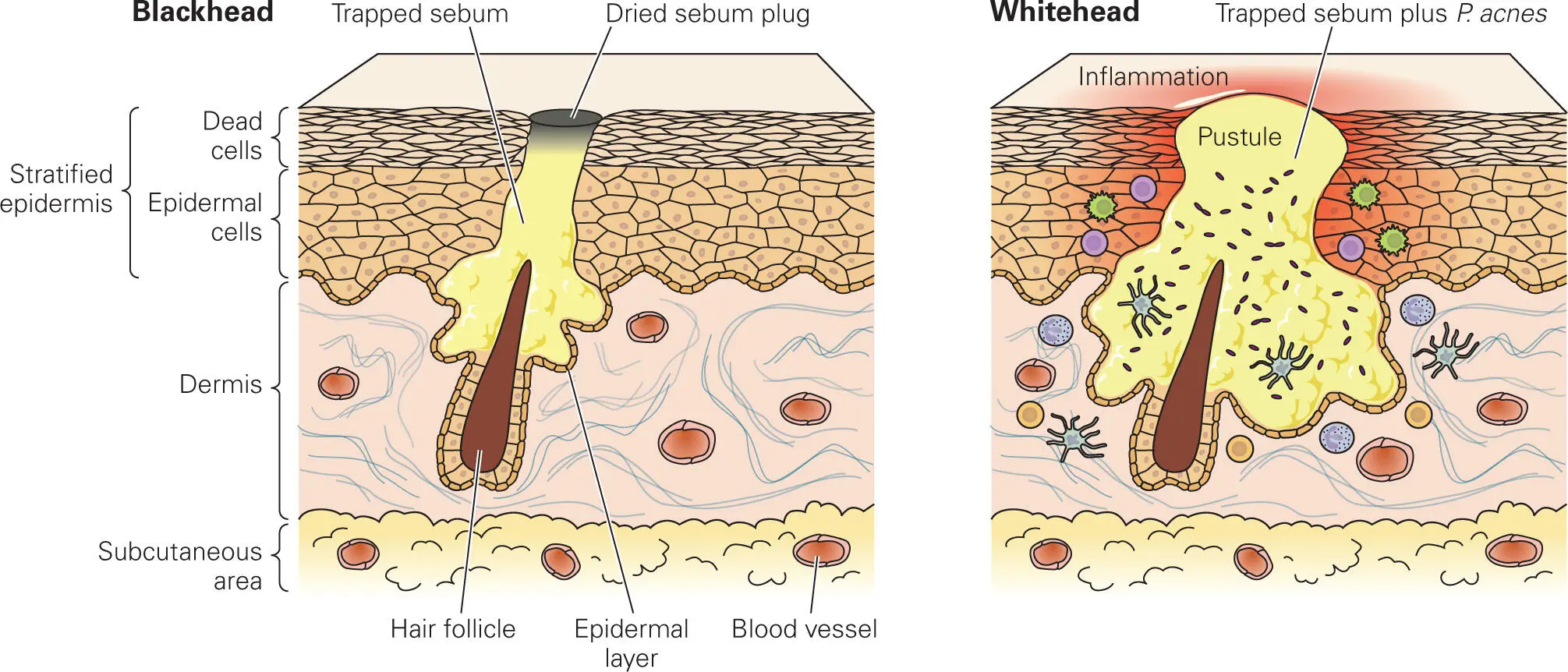 Figure 24 Skin infection with the commensal bacteria Overgrowth of the - фото 15