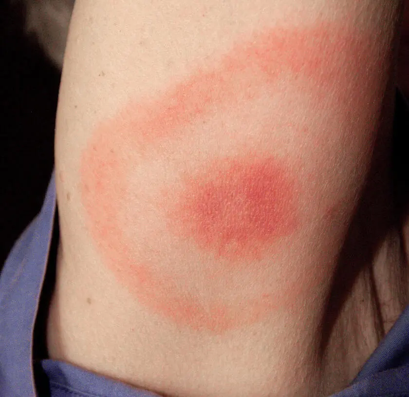 Figure 1 The characteristic bullseye rash erythema migrans caused by Lyme - фото 63
