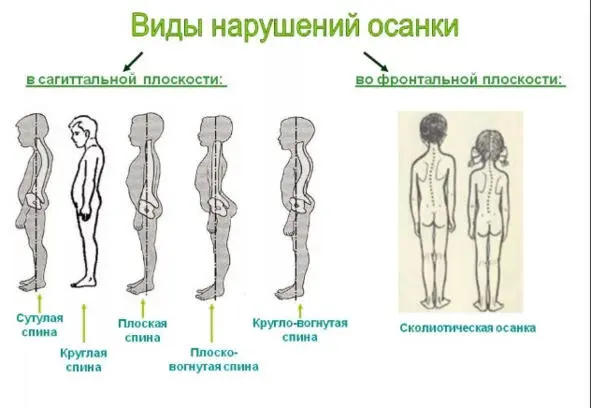 В медицине определены следующие разновидности неправильной осанки - фото 1