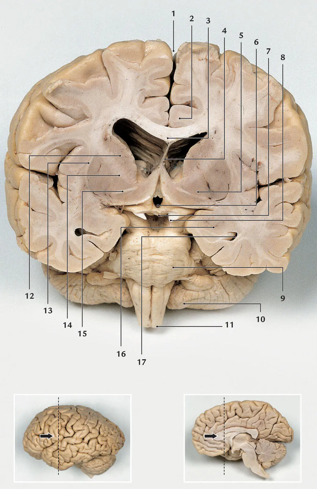 Abb 218 Frontalschnitt im Bereich des mittleren Septum pellucidum und des - фото 23