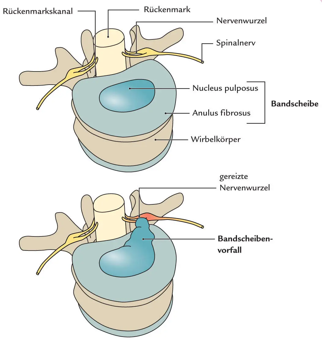 Abb 314 Pathophysiologie des Bandscheibenvorfalls Im fortgeschrittenen Alter - фото 30