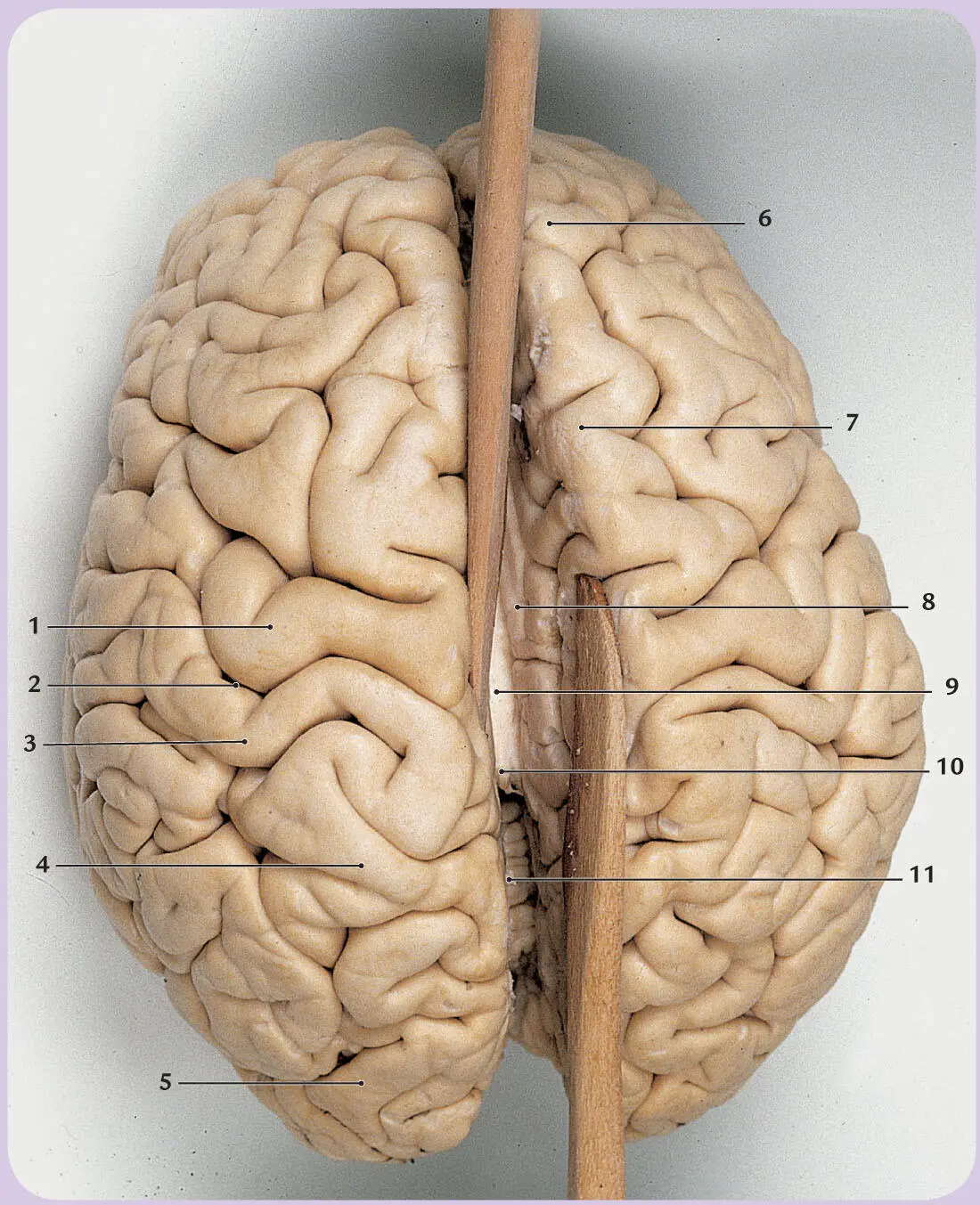 Abb 25 Gehirn von oben Hirnhäute vollständig entfernt beide Hemisphären des - фото 19