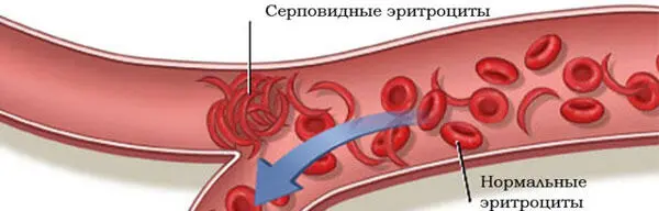 рис 5 Эритроциты больного серповидноклеточной анемией Округлые клетки - фото 5