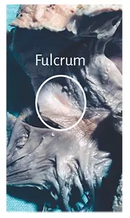 Figure 125 Fulcrum in the adult human heart Figure 126 Fulcrum resected - фото 12