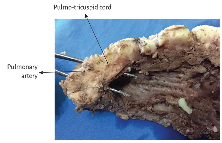 Figure 117 Panoramic view of the pulmotricuspid cord An osseus formation - фото 8