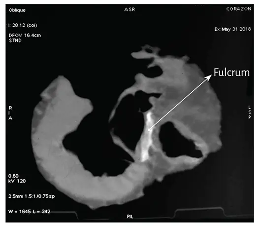 Figure 142 Computed Tomography In the area indicated by the arrow there is - фото 19