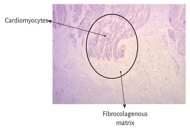 Figure 138 Cardiomyocytes penetrating the fibrocolagenous tissue adult human - фото 17