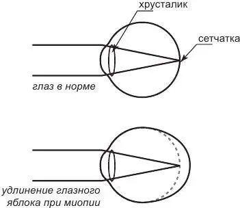Изза аномалии рефракции изображение фокусируется не на сетчатке глаза а перед - фото 3