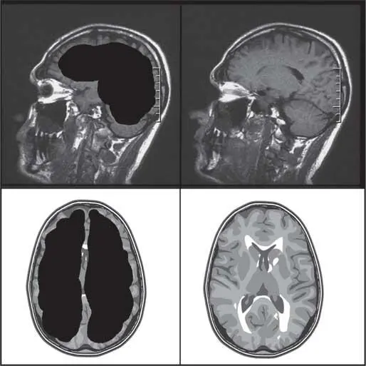 Рис 1 Слева мозг Матье реконструкция справа мозг здорового человека - фото 1