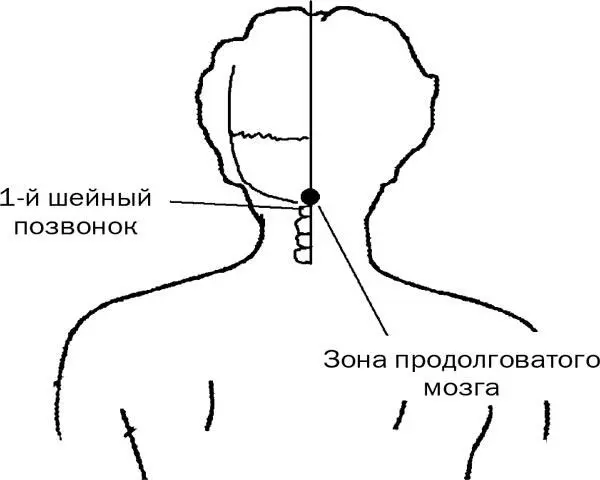 Рис 7 При носовом кровотечении 1 Сначала традиционно затыкаем ноздри ватой и - фото 21